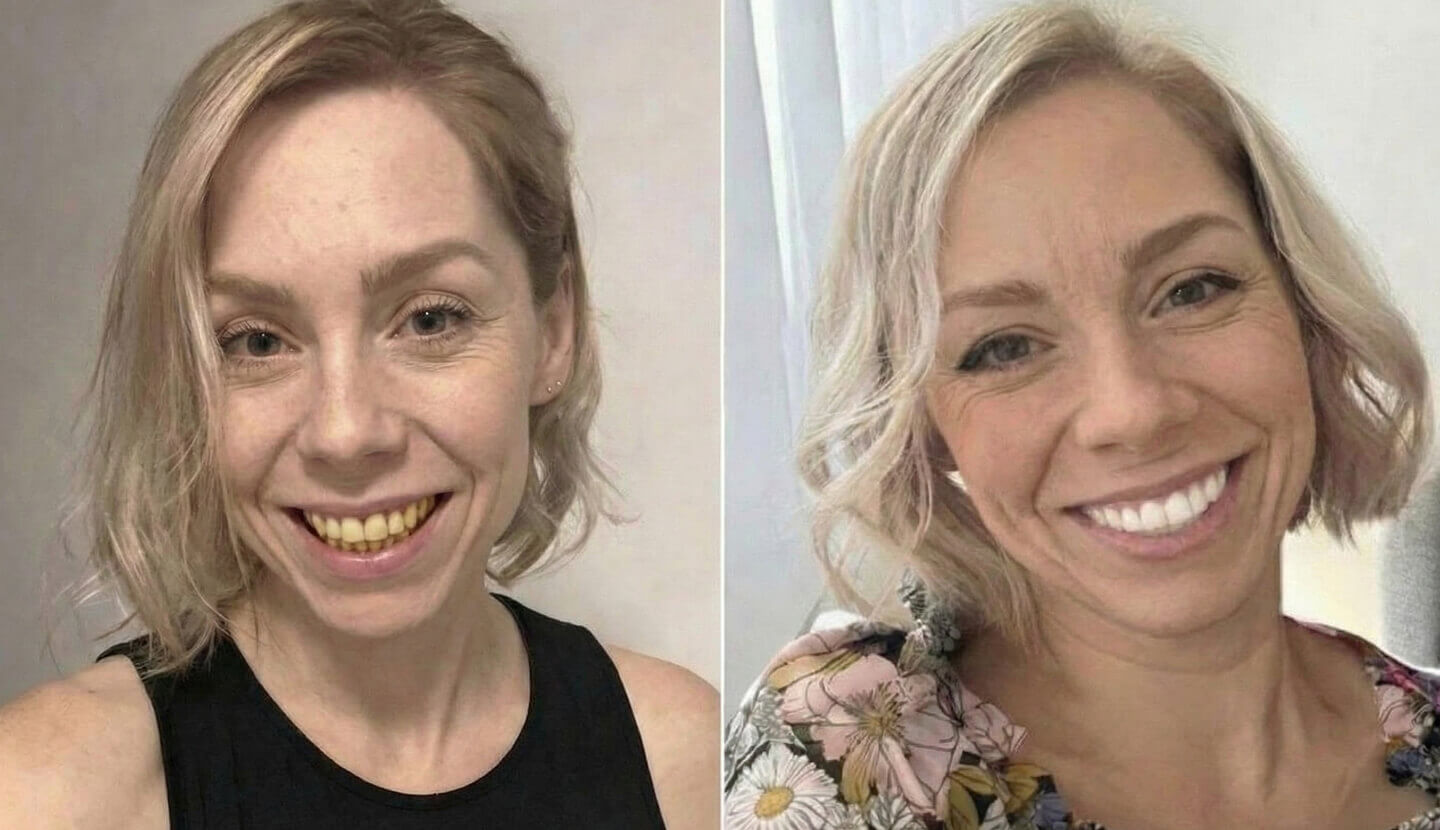 Teeth whitening before and after results