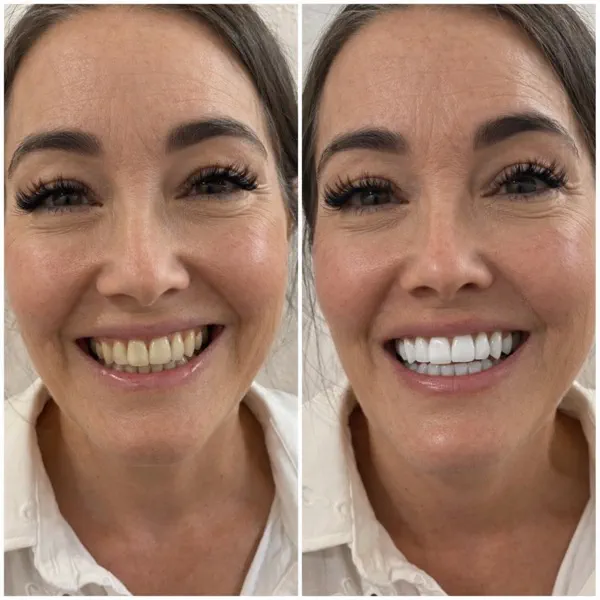 Before and after teeth whitening