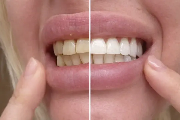 Before and after teeth whitening