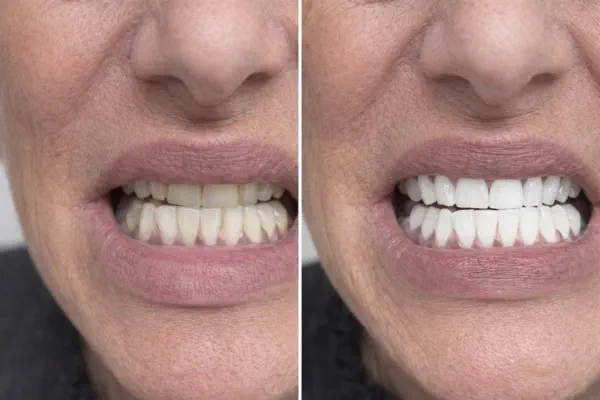 Before and after teeth whitening