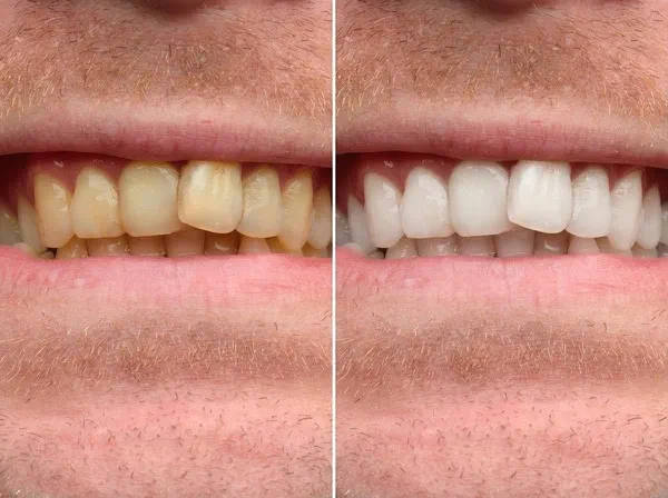 Before and after teeth whitening