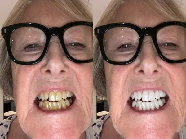 Before and after teeth whitening